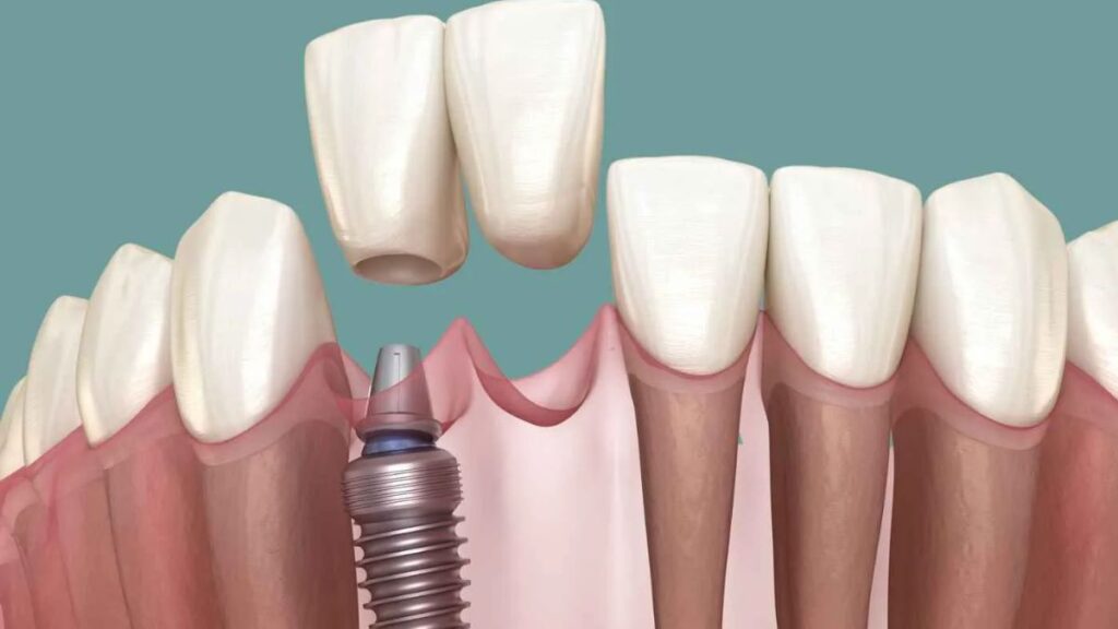 Dental Implants