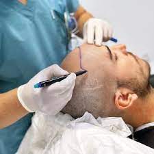 hair transplant london