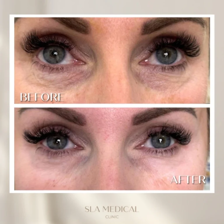 Polynucleotides Under Eyes in Manchester