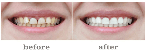 teeth whitening